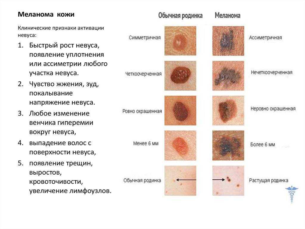 Меланома у собак и кошек: причины, симптомы, диагностика, лечение