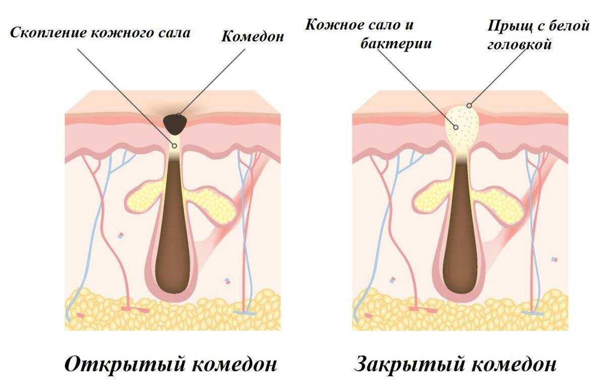 Чёрные точки (акне) у кошки и кота на подбородке: причины, как лечить котенка и взрослое животное в домашних условиях