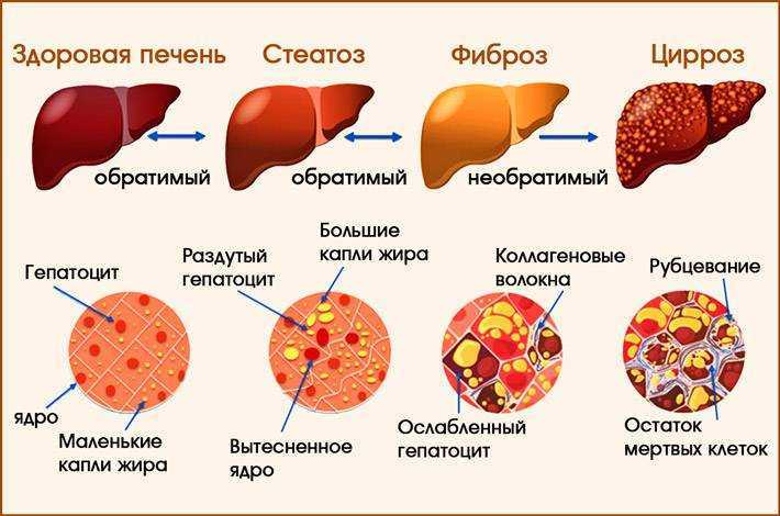 Что такое фиброз печени? причины, признаки, симптомы, методы диагностики и лечения фиброза печени - «гепатит.ру»