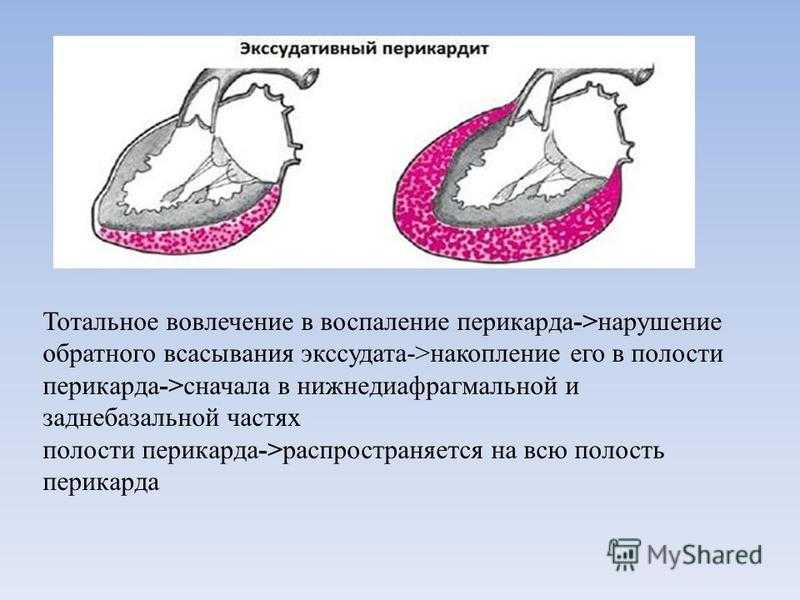Перикардит у кошек