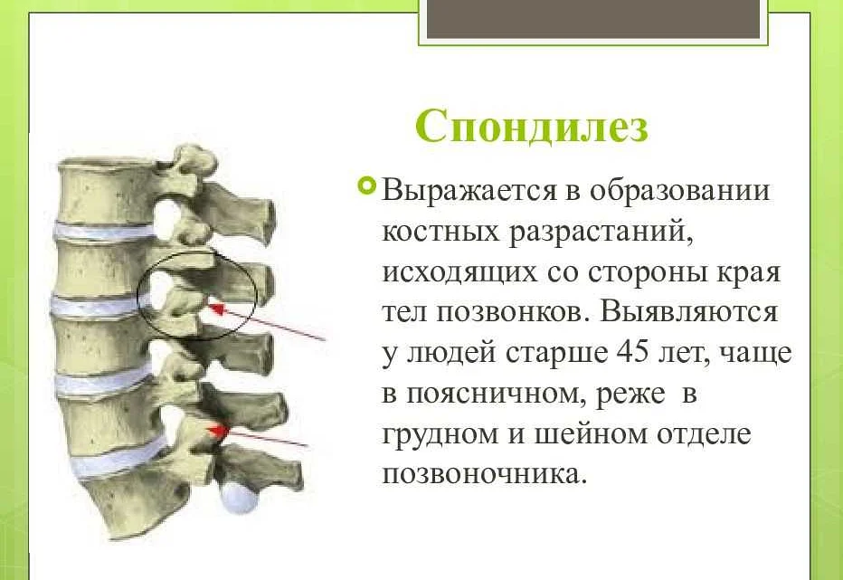 Чем отличается спондилез от спондилеза. Спондилез с3-с7 позвонков. Спондилез и остеохондроз поясничного отдела позвоночника. Спондилез 2 степени поясничного отдела позвоночника. Спондилеза l1-l5.