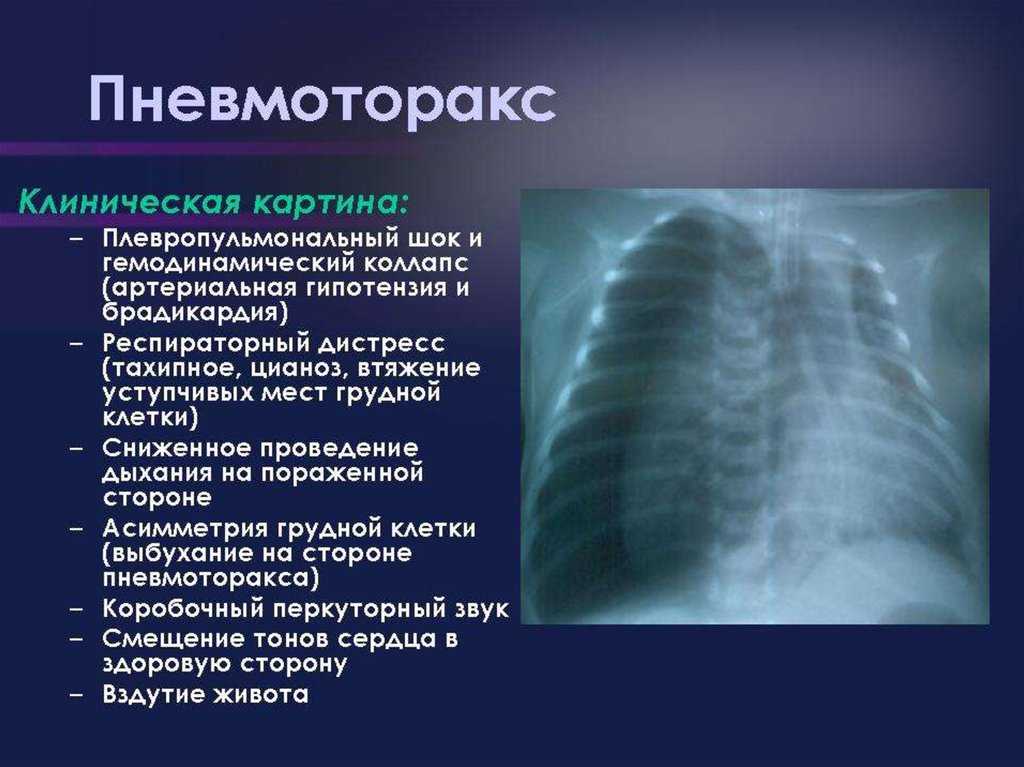 7 важных аспектов равзвития пневмоторакса у домашних животных (особенности течения и терапии у собак, кошек, лошадей и крс)