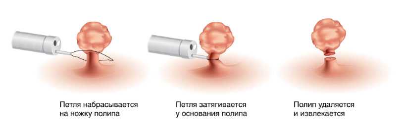 Полипы в носу у кошки: причины образования, методы диагностики,лечение полипов