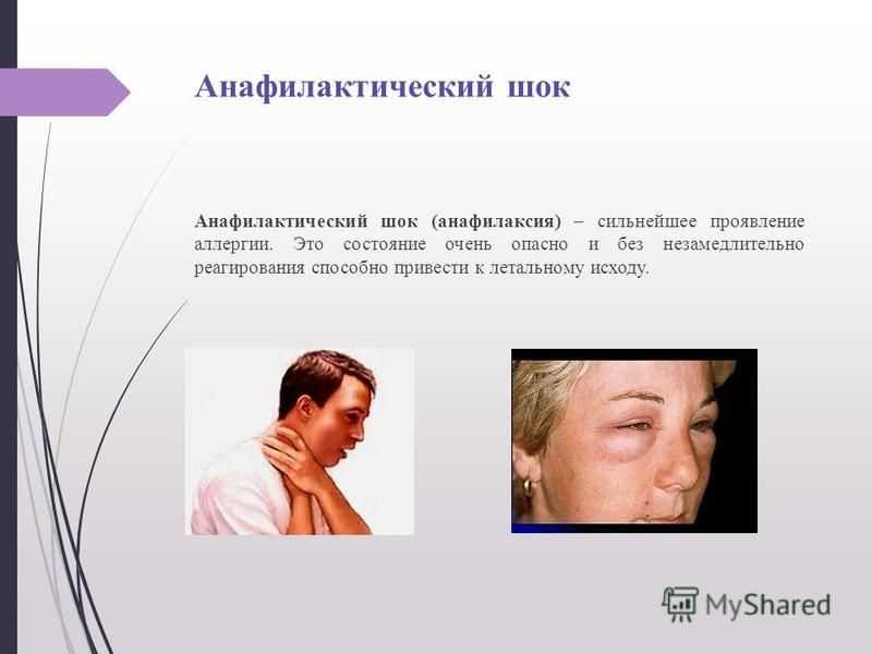 Симптомы отека квинке у кошек